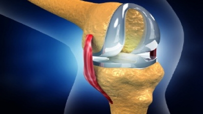 Total knee replacement components image